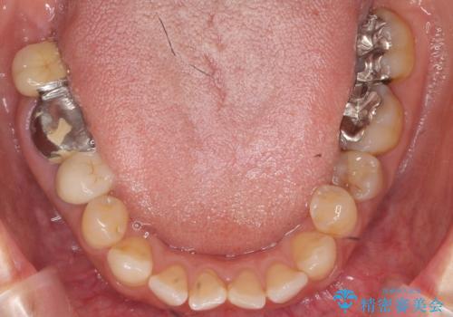 奥歯が割れている　抜歯してインプラントへ　40代女性の治療前