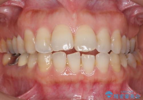 奥歯が割れている 抜歯してインプラントへ 40代女性の治療前