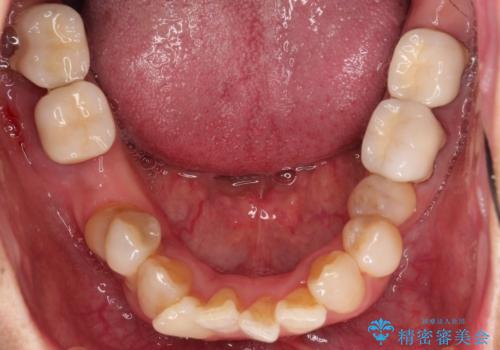 歯並びや奥歯の痛み 色々と治したい 総合歯科診療の治療前