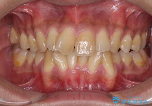 上顎の狭い歯列をインビザラインで拡大の症例 治療前