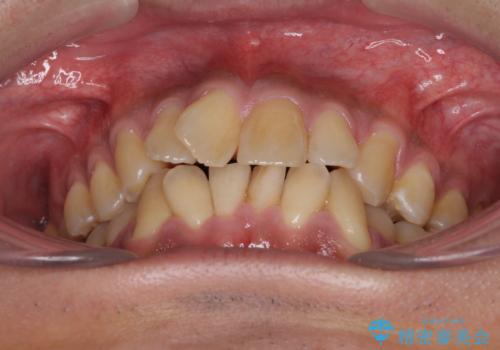 上顎の狭い歯列をインビザラインで拡大の治療前