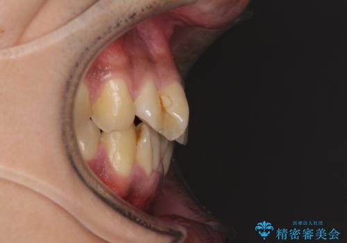 上顎の狭い歯列をインビザラインで拡大の治療前