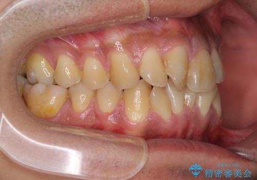上顎の狭い歯列をインビザラインで拡大の治療前