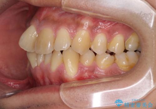 上顎の狭い歯列をインビザラインで拡大の治療前