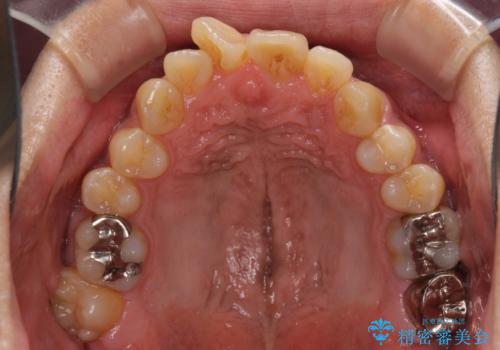 上顎の狭い歯列をインビザラインで拡大の治療前