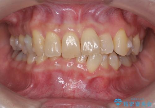 50代女性 インビザライン かみ合わせが深く、難しい症例の治療中