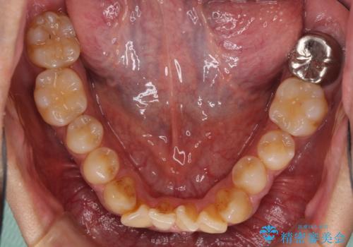 上顎の狭い歯列をインビザラインで拡大の治療前