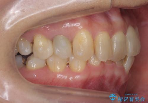 50代女性 インビザライン かみ合わせが深く、難しい症例の治療中