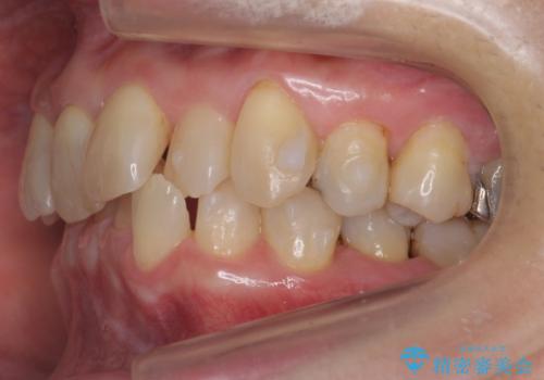 50代女性 インビザライン かみ合わせが深く、難しい症例の治療中