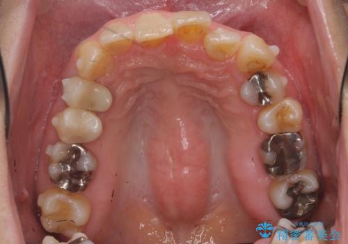 50代女性 インビザライン かみ合わせが深く、難しい症例の治療中