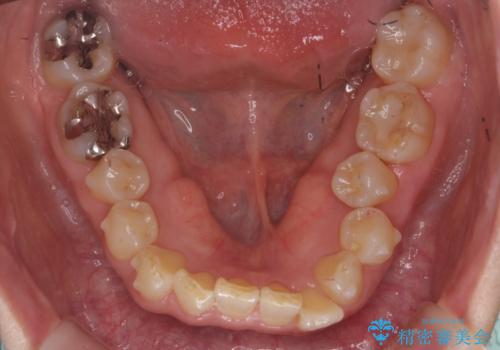 50代女性 インビザライン かみ合わせが深く、難しい症例の治療中