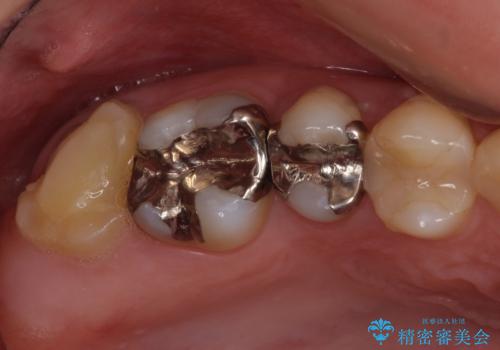 奥歯のむし歯が痛む　セラミッククラウンとゴールドインレーによるむし歯治療の治療前