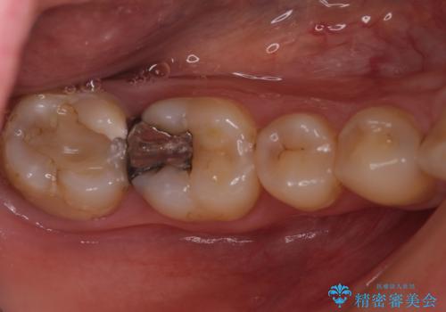 奥歯のむし歯が痛む セラミッククラウンとゴールドインレーによるむし歯治療の治療前