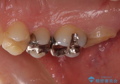 奥歯のむし歯が痛む セラミッククラウンとゴールドインレーによるむし歯治療の治療前