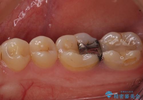 奥歯のむし歯が痛む　セラミッククラウンとゴールドインレーによるむし歯治療の治療前