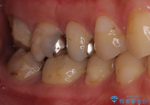 奥歯のむし歯が痛む　セラミッククラウンとゴールドインレーによるむし歯治療の症例 治療前