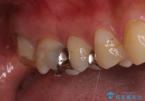 奥歯のむし歯が痛む セラミッククラウンとゴールドインレーによるむし歯治療の治療前