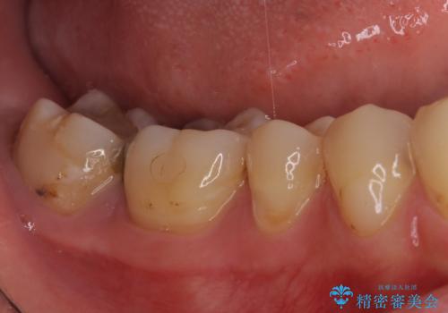 奥歯のむし歯が痛む セラミッククラウンとゴールドインレーによるむし歯治療の治療前
