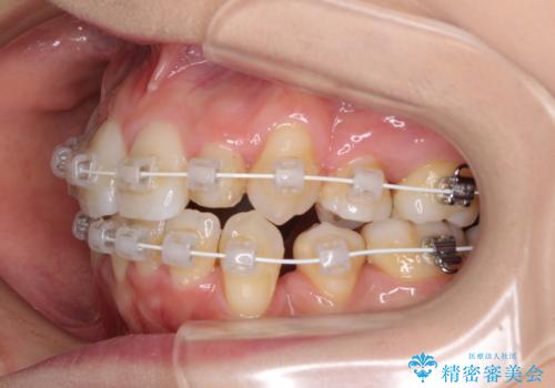 結婚式までに前歯をきれいにしたい 抜歯矯正とオールセラミッククラウンの治療中