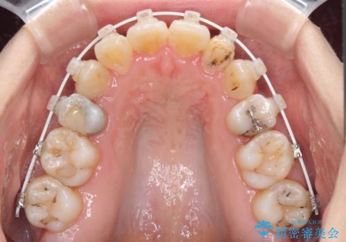 結婚式までに前歯をきれいにしたい　抜歯矯正とオールセラミッククラウンの治療中
