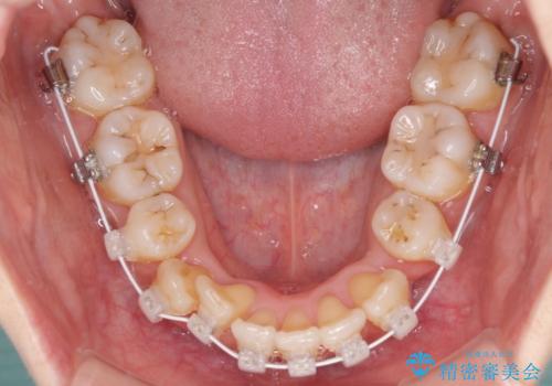 結婚式までに前歯をきれいにしたい　抜歯矯正とオールセラミッククラウンの治療中