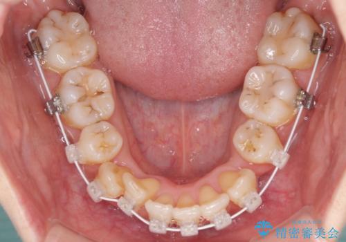 結婚式までに前歯をきれいにしたい 抜歯矯正とオールセラミッククラウンの治療中