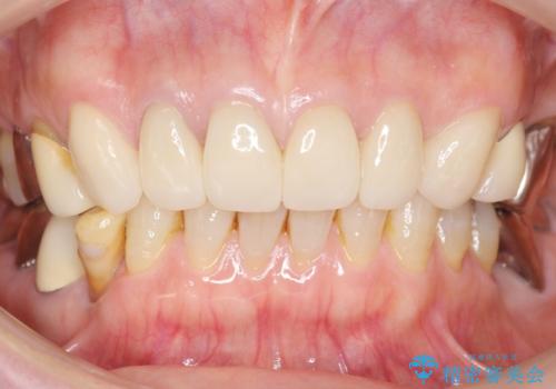 長持ちするセラミック 4年半経過症例 50代女性の治療後