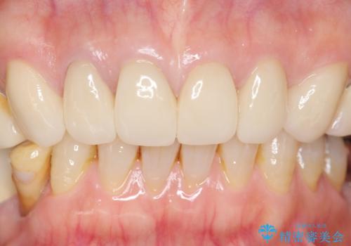 長持ちするセラミック 4年半経過症例 50代女性の治療後