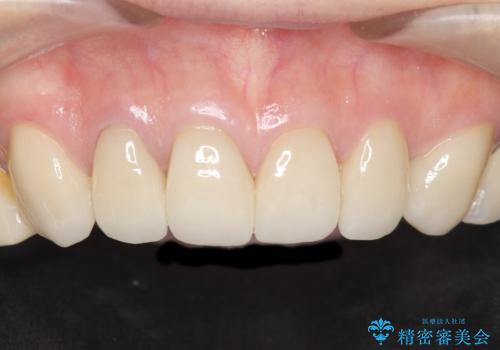 長持ちするセラミック 4年半経過症例 50代女性の症例 治療後