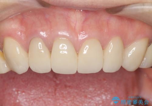 長持ちするセラミック 4年半経過症例 50代女性の治療後