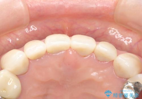 長持ちするセラミック 4年半経過症例 50代女性の治療後