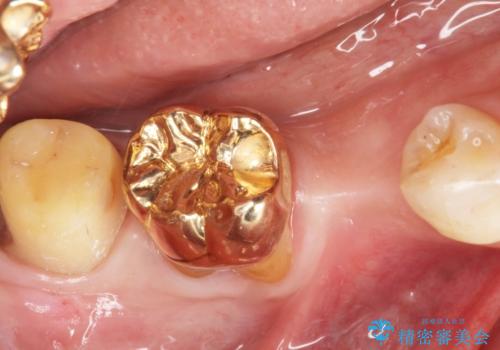 親知らずのせいで隣の歯が虫歯に 40代男性の治療中