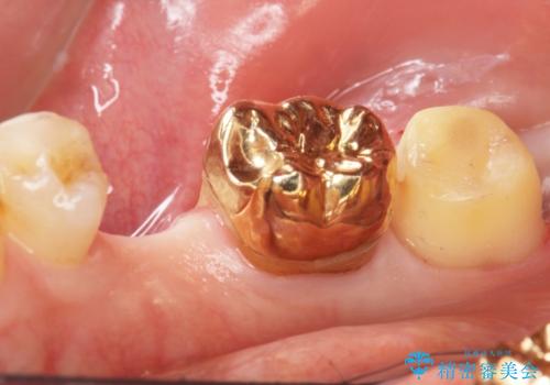 親知らずのせいで隣の歯が虫歯に 40代男性の治療中