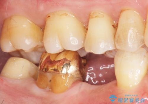 親知らずのせいで隣の歯が虫歯に 40代男性の治療中