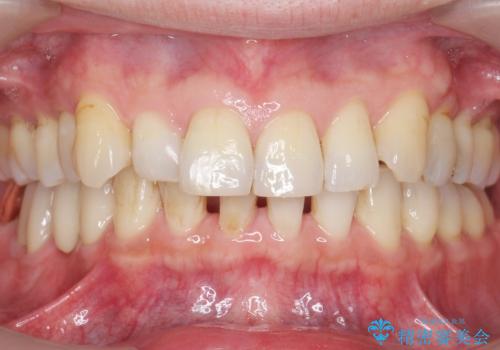 親知らずのせいで隣の歯が虫歯に 40代男性の治療後