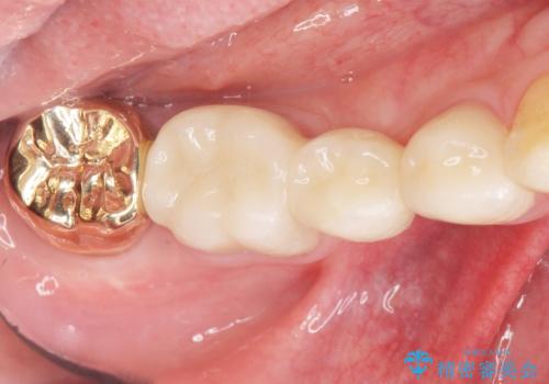 親知らずのせいで隣の歯が虫歯に 40代男性の治療後