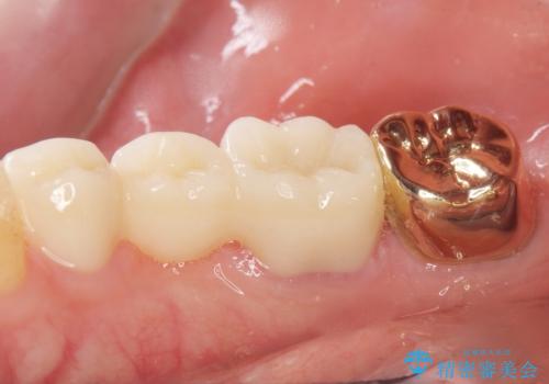 親知らずのせいで隣の歯が虫歯に 40代男性の治療後