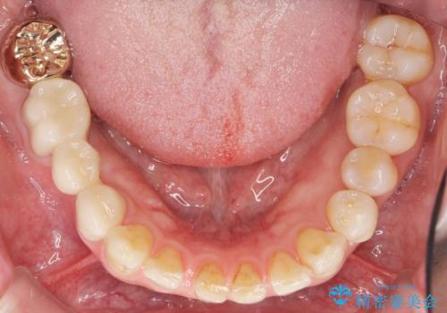親知らずのせいで隣の歯が虫歯に　40代男性の治療後