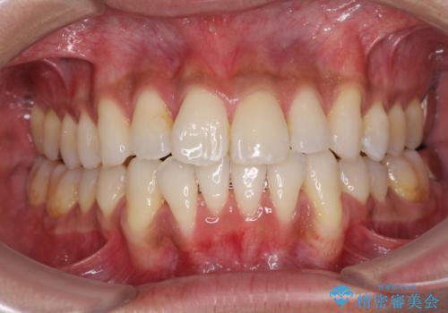 上顎の狭い歯列をインビザラインで拡大の治療中