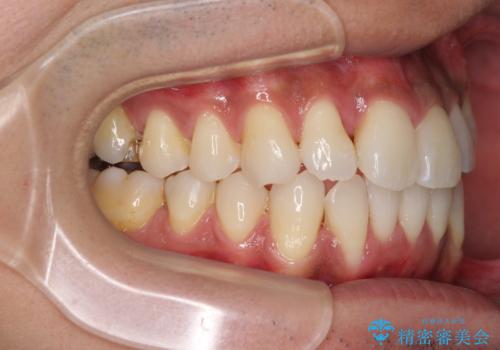 上顎の狭い歯列をインビザラインで拡大の治療中