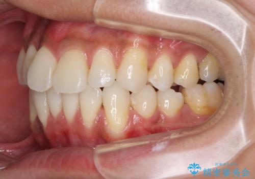 上顎の狭い歯列をインビザラインで拡大の治療中