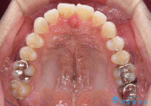 上顎の狭い歯列をインビザラインで拡大の治療中