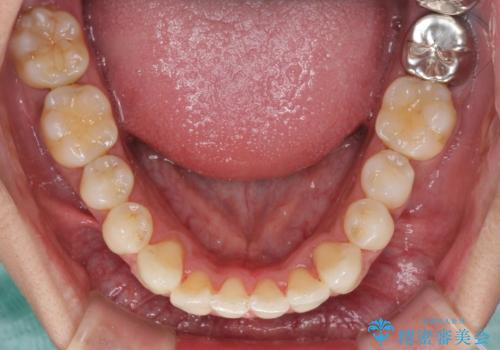 上顎の狭い歯列をインビザラインで拡大の治療中