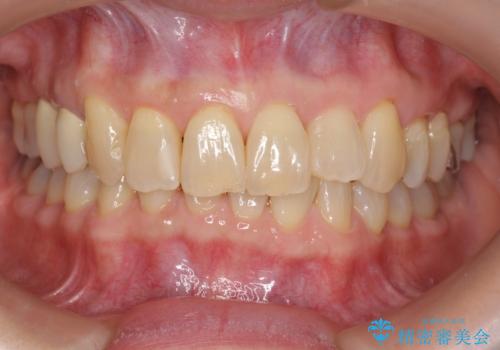 50代女性 インビザライン かみ合わせが深く、難しい症例の症例 治療後