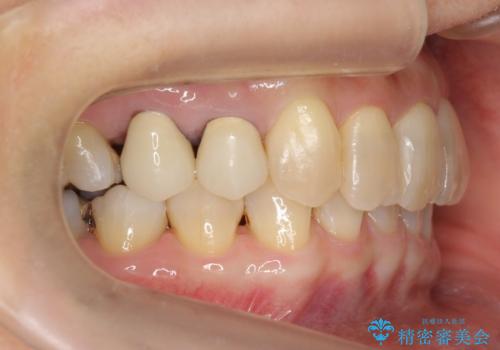 50代女性 インビザライン かみ合わせが深く、難しい症例の治療後