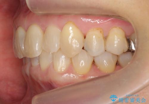 50代女性 インビザライン かみ合わせが深く、難しい症例の治療後