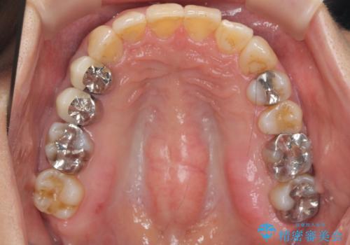 50代女性 インビザライン かみ合わせが深く、難しい症例の治療後