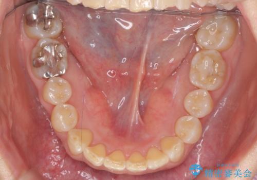 50代女性 インビザライン かみ合わせが深く、難しい症例の治療後