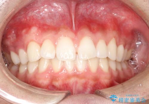 前歯の隙間がきになる　インビザラインですきっ歯の治療の症例 治療前