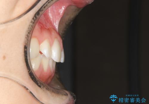 前歯の隙間がきになる インビザラインですきっ歯の治療の治療前